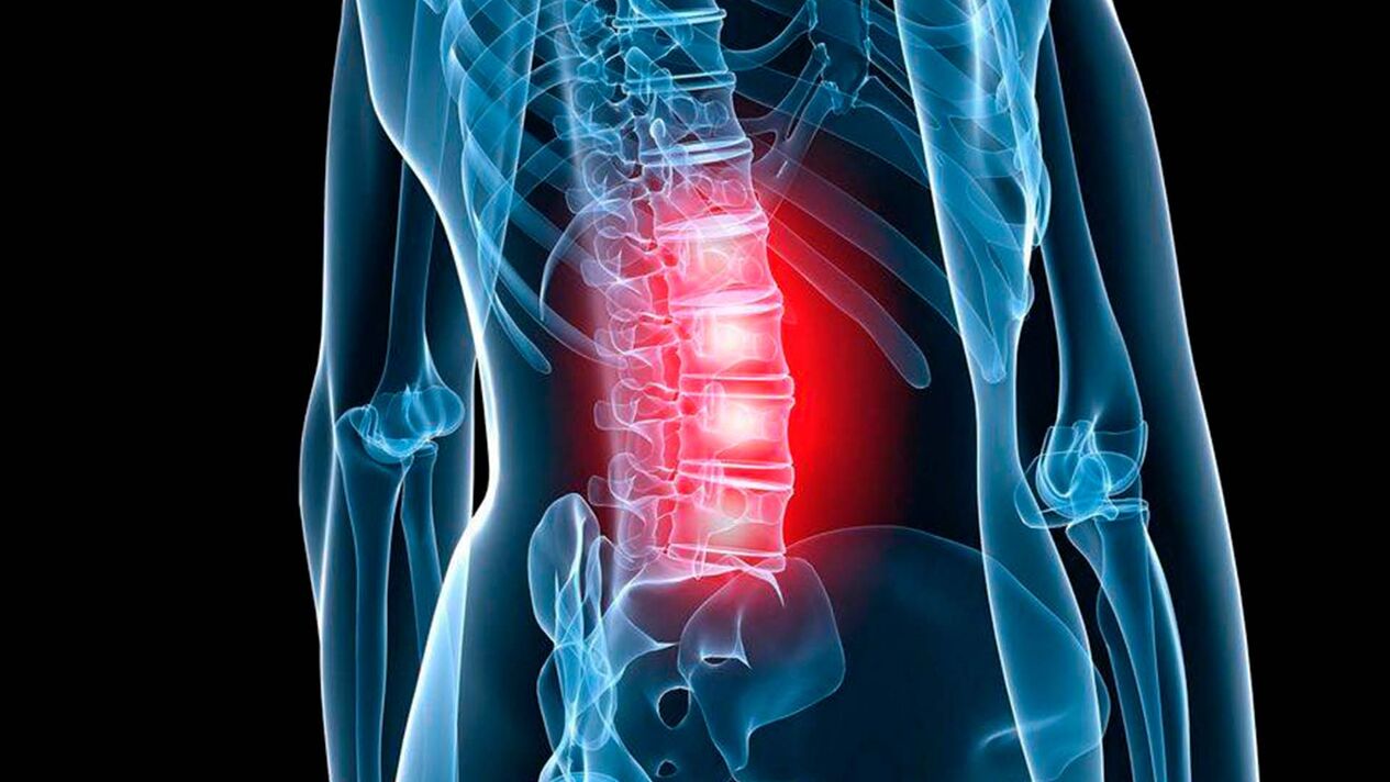 Symptome einer lumbalen Osteochondrose