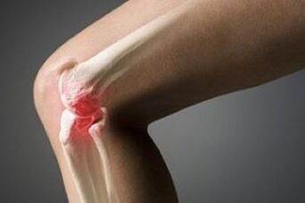 Die Arthrose des Kniegelenks ist eine Verletzung des Knorpelgewebes