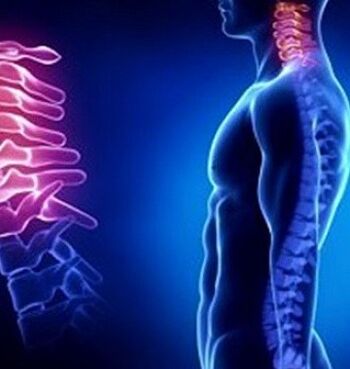 Zervikale Osteochondrose kann durch Verletzungen des Nackens verursacht werden