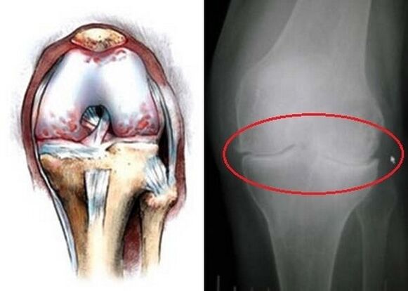 Arthrose des Kniegelenks