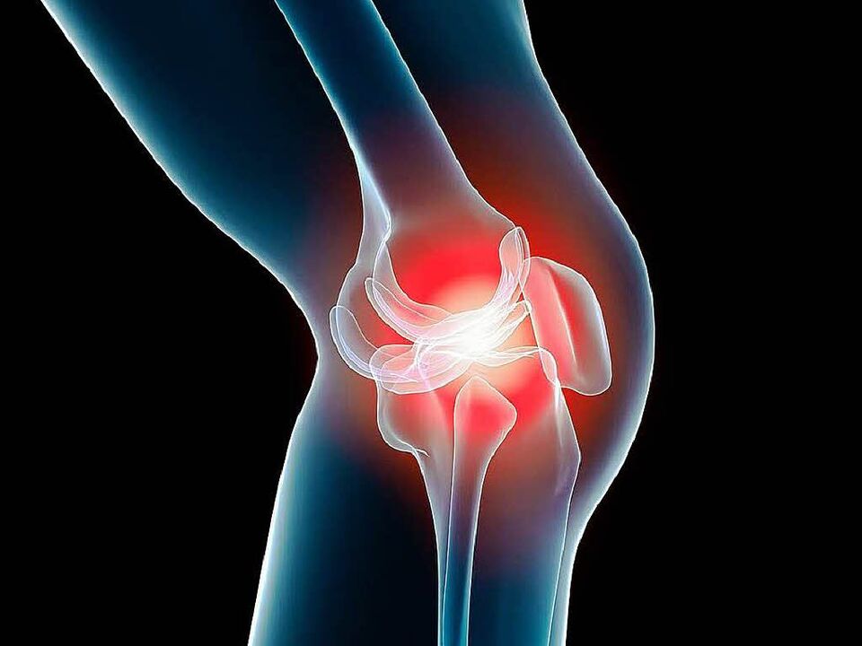 Arthrose des Knies